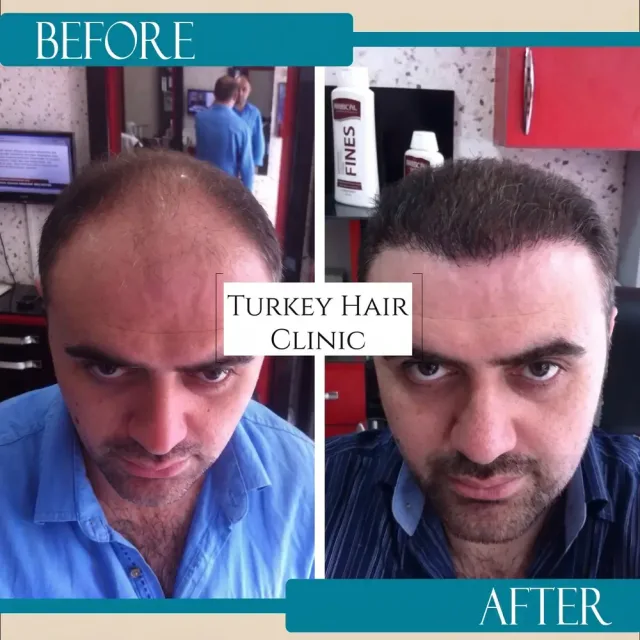 Saç ekimi öncesi ve sonrası kolaj — Turkey Hair Clinic, sonuç 2