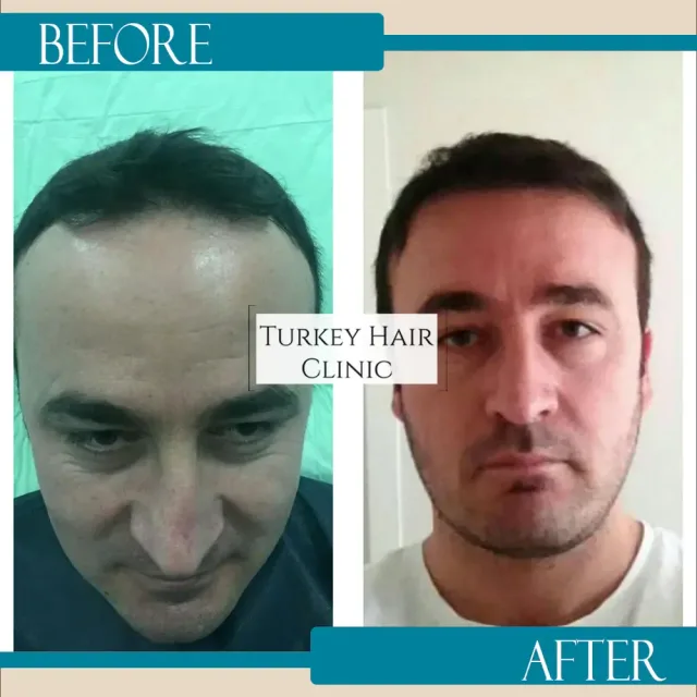 Hair transplant before and after collage — Turkey Hair Clinic, result 7