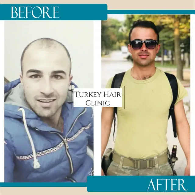 Hair transplant before and after collage — Turkey Hair Clinic, result 13
