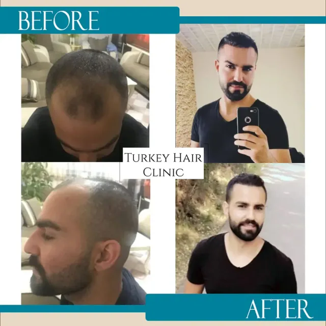Hair transplant before and after collage — Turkey Hair Clinic, result 15