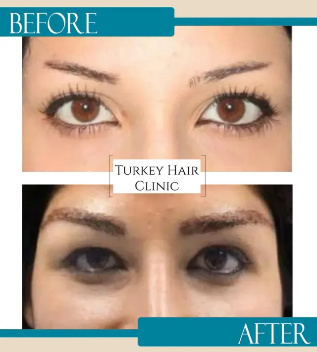 Hair transplant before and after collage — Turkey Hair Clinic, result 16