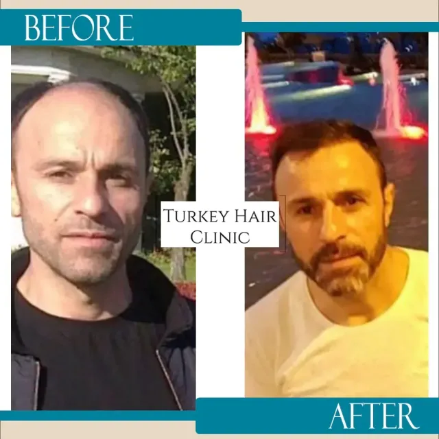 Hair transplant before and after collage — Turkey Hair Clinic, result 19