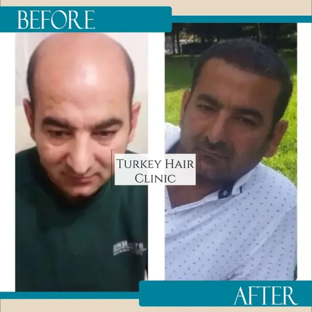 Hair transplant before and after collage — Turkey Hair Clinic, result 25