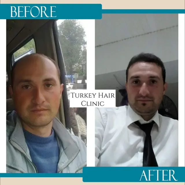 Hair transplant before and after collage — Turkey Hair Clinic, result 26