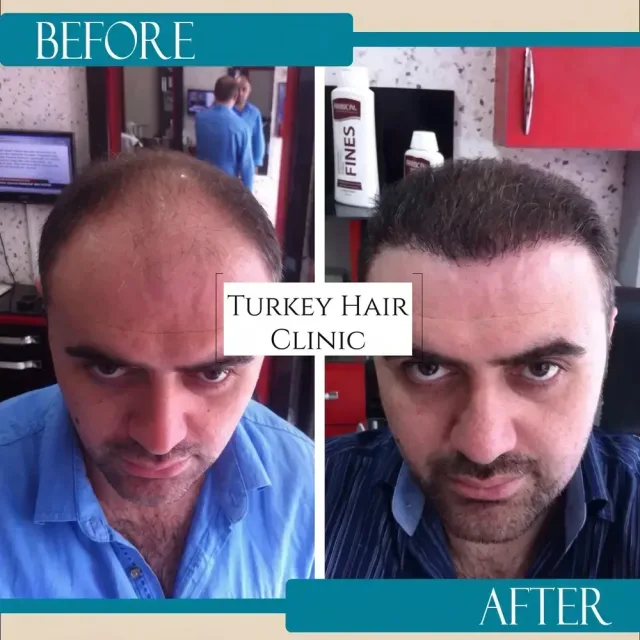 Hair transplant before and after collage — Turkey Hair Clinic, result 34
