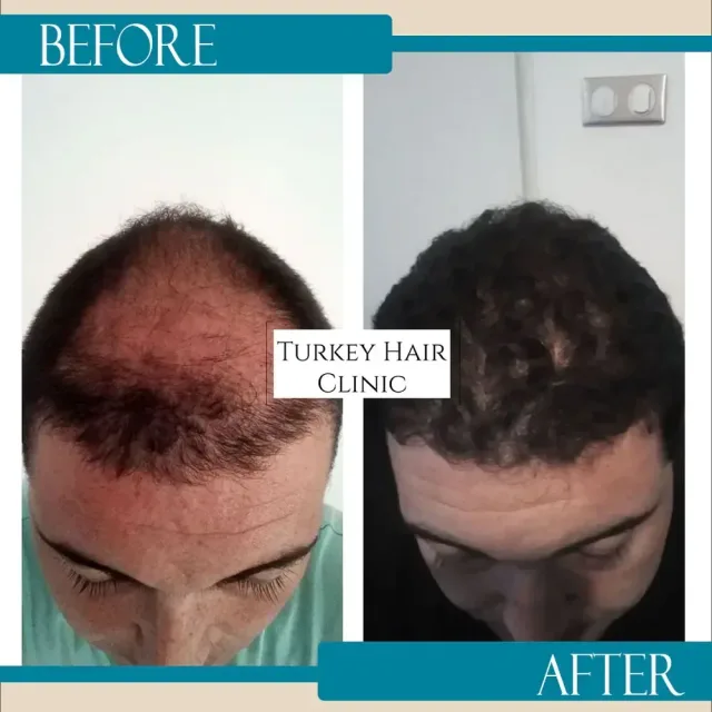 Hair transplant before and after collage — Turkey Hair Clinic, result 40