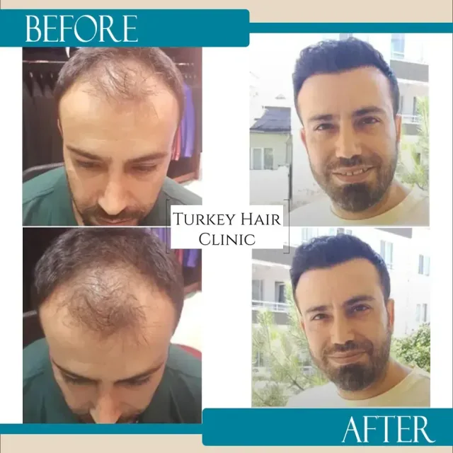 Hair transplant before and after collage — Turkey Hair Clinic, result 46