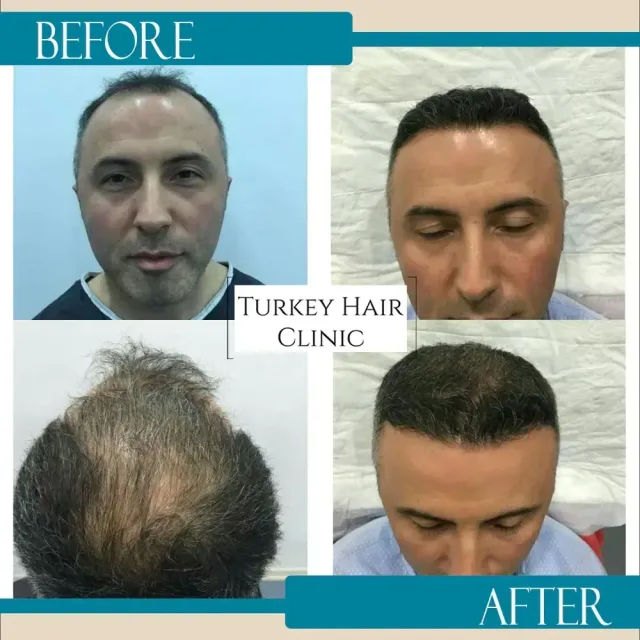Hair transplant before and after collage — Turkey Hair Clinic, result 52