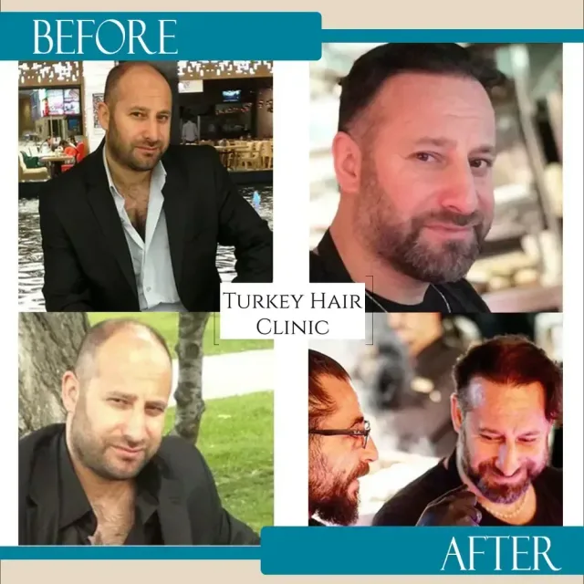 Hair transplant before and after collage — Turkey Hair Clinic, result 60