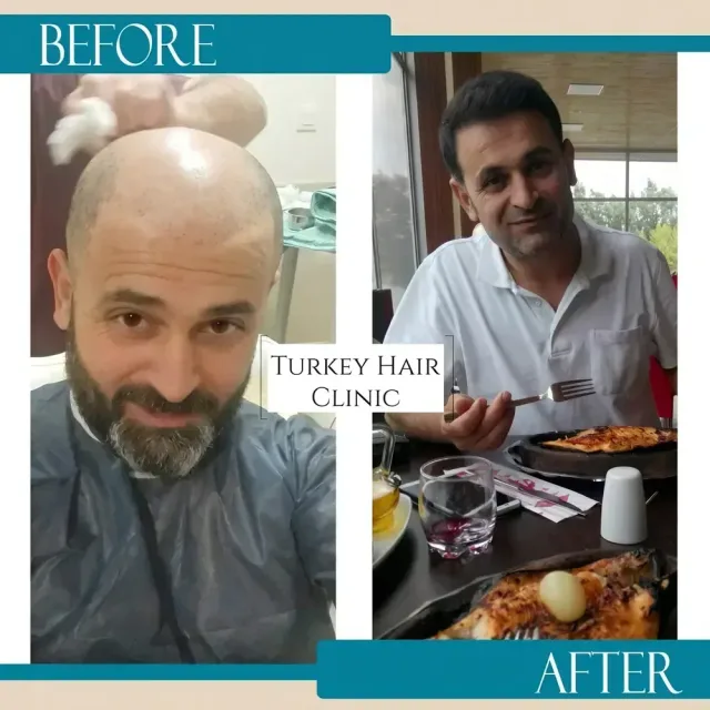 Hair transplant before and after collage — Turkey Hair Clinic, result 65