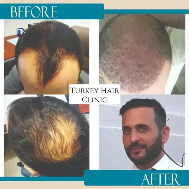 Hair transplant before and after collage — Turkey Hair Clinic, result 69