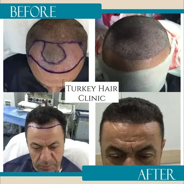 Hair transplant before and after collage — Turkey Hair Clinic, result 70