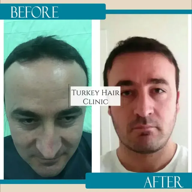 Hair transplant before and after collage — Turkey Hair Clinic, result 71