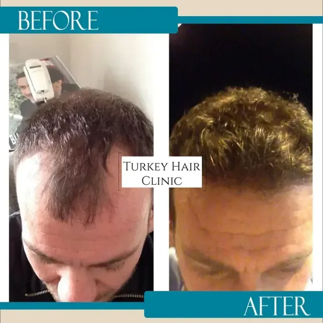 Hair transplant before and after collage — Turkey Hair Clinic, result 75